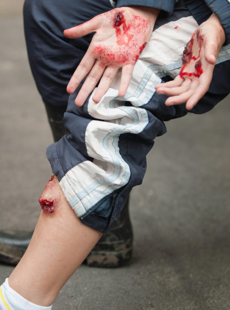 Realistically simulated serious injuries of leg and hands